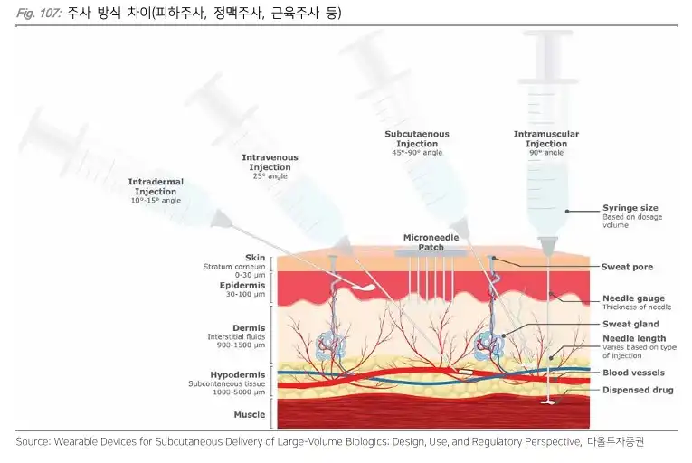 알테오젠 주사 방식 차이(피하주사, 정맥주사, 근육주사)